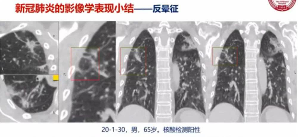 AI助力疫情防控，專利為其保駕護航！